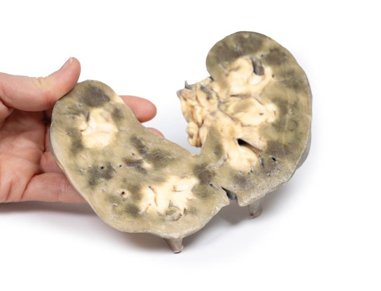 3D Printed Horseshoe Kidney