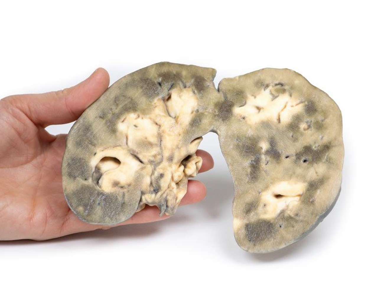 3D Printed Horseshoe Kidney