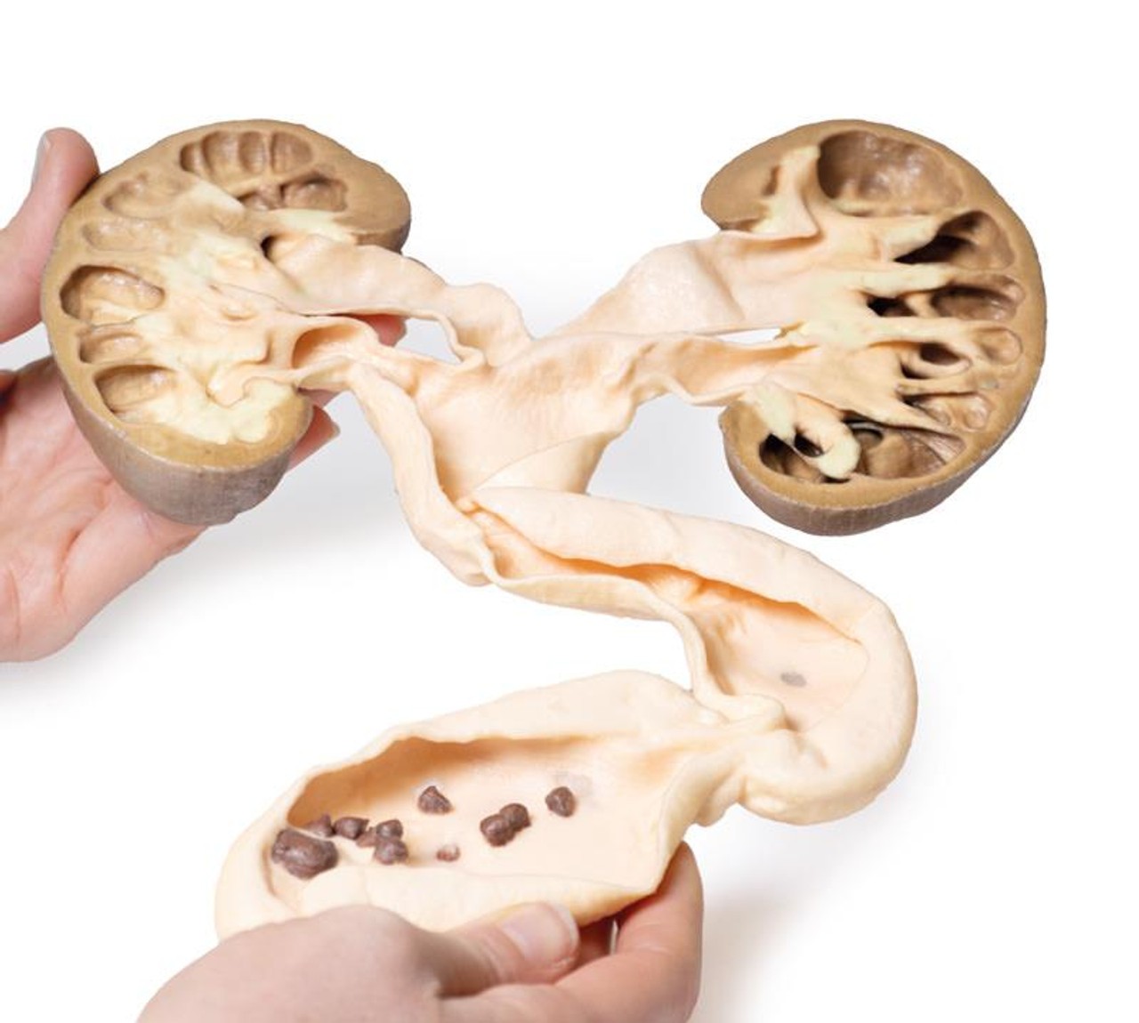 3D Printed Hydronephrosis Hydroureter