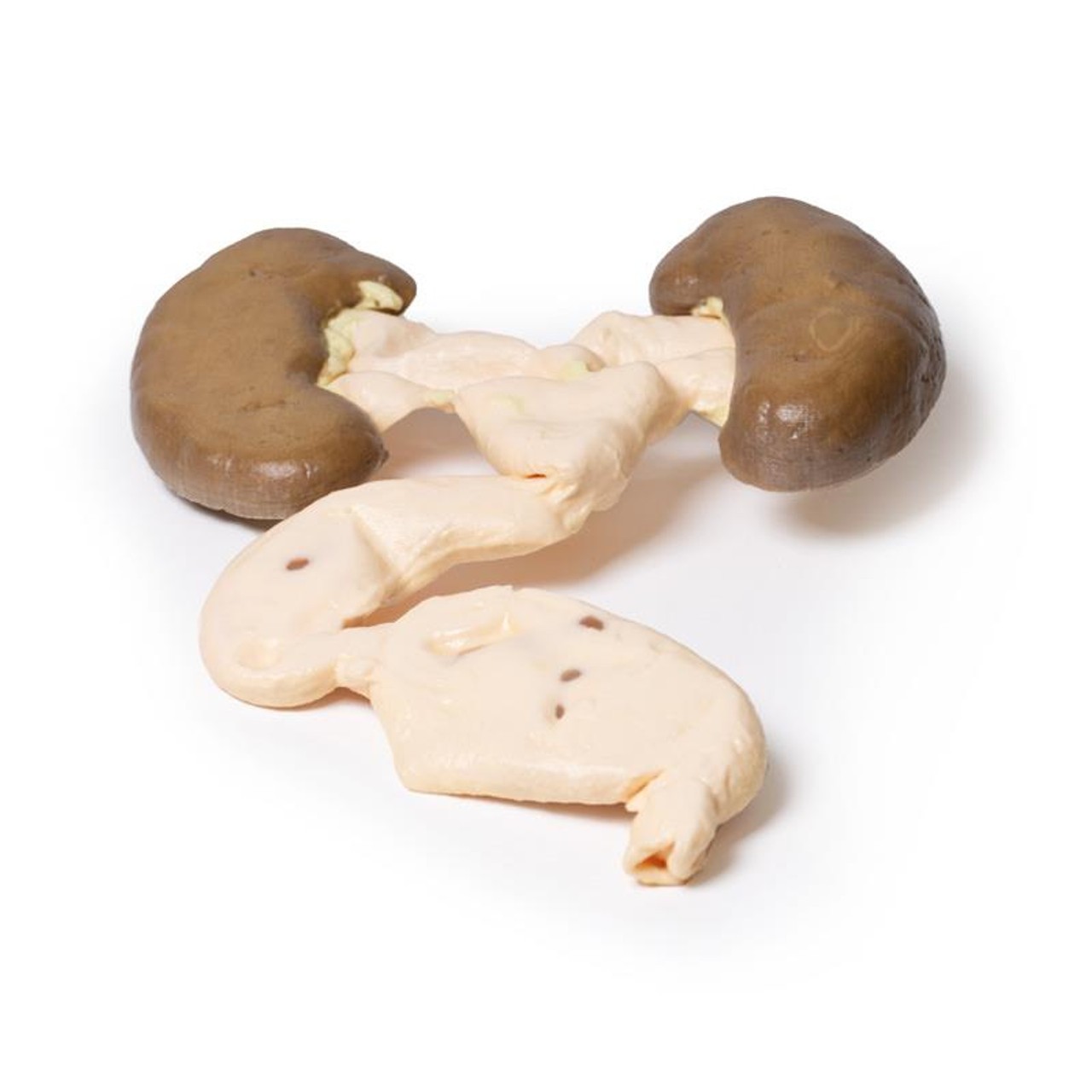 3D Printed Hydronephrosis Hydroureter