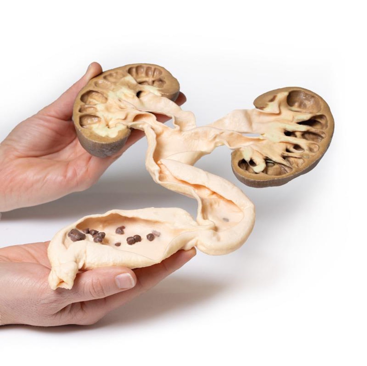3D Printed Hydronephrosis Hydroureter