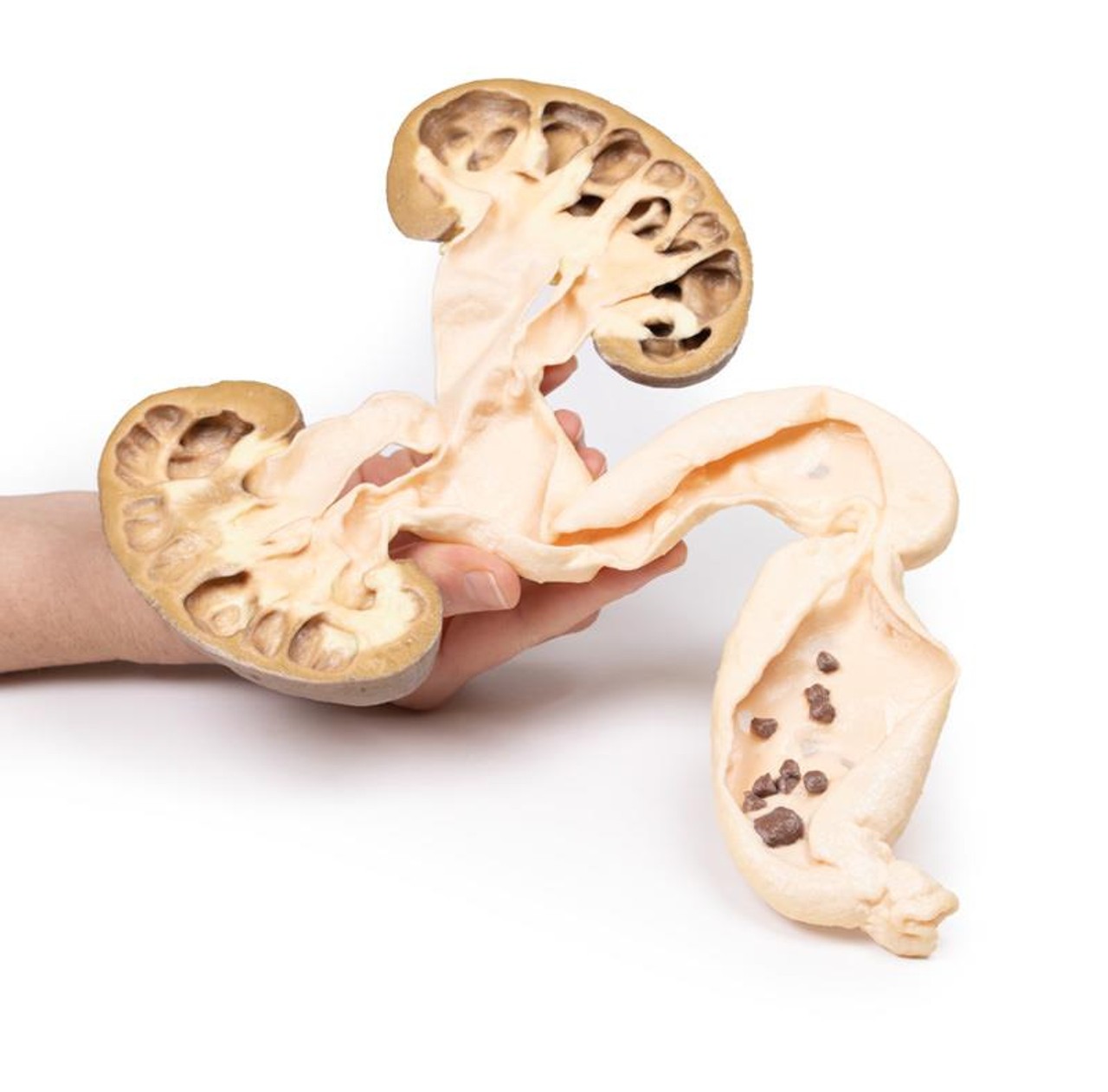 3D Printed Hydronephrosis Hydroureter