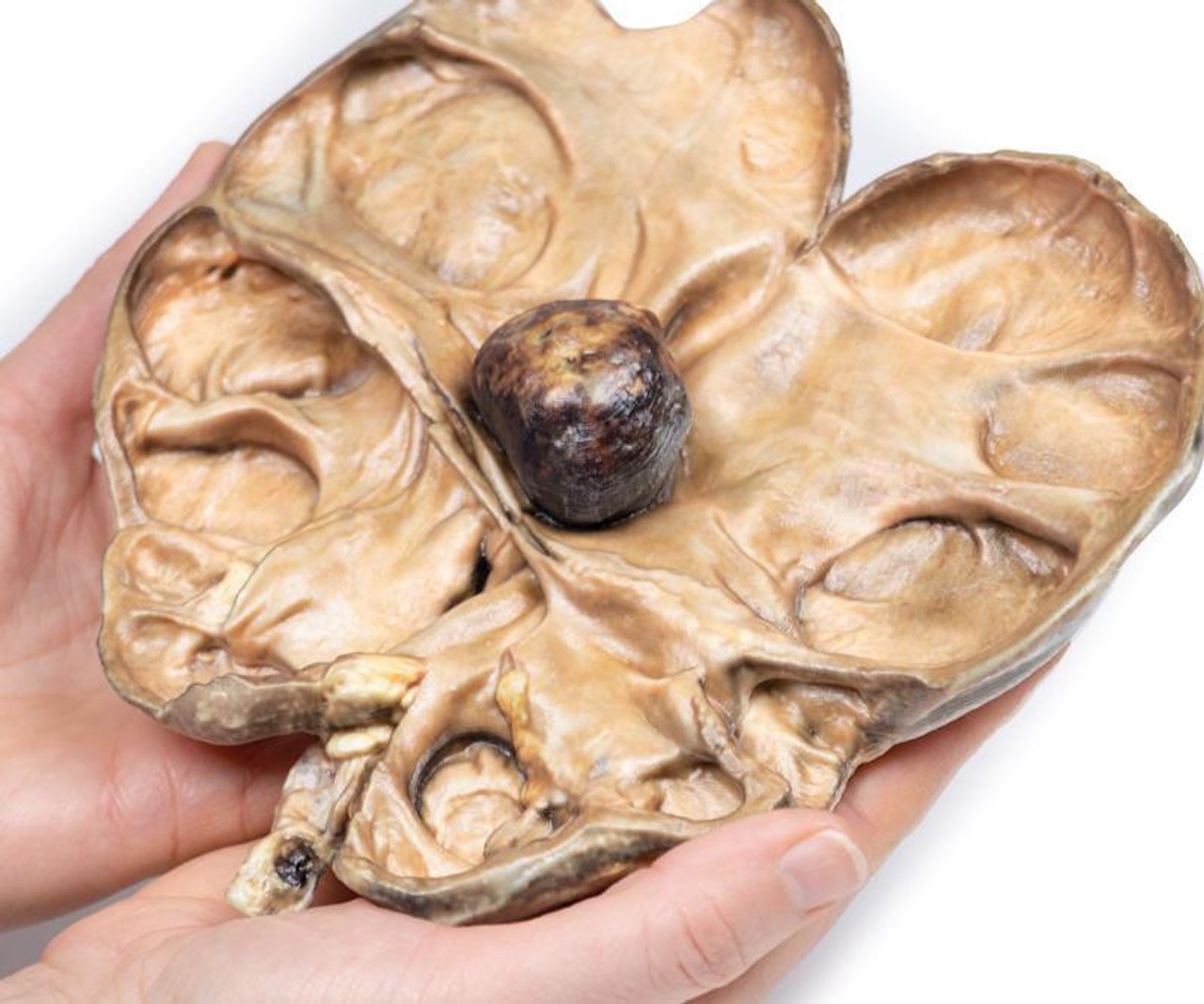 3D Printed Hydronephrosis and Hydroureter Caused by Obstruction by a Renal Calculus
