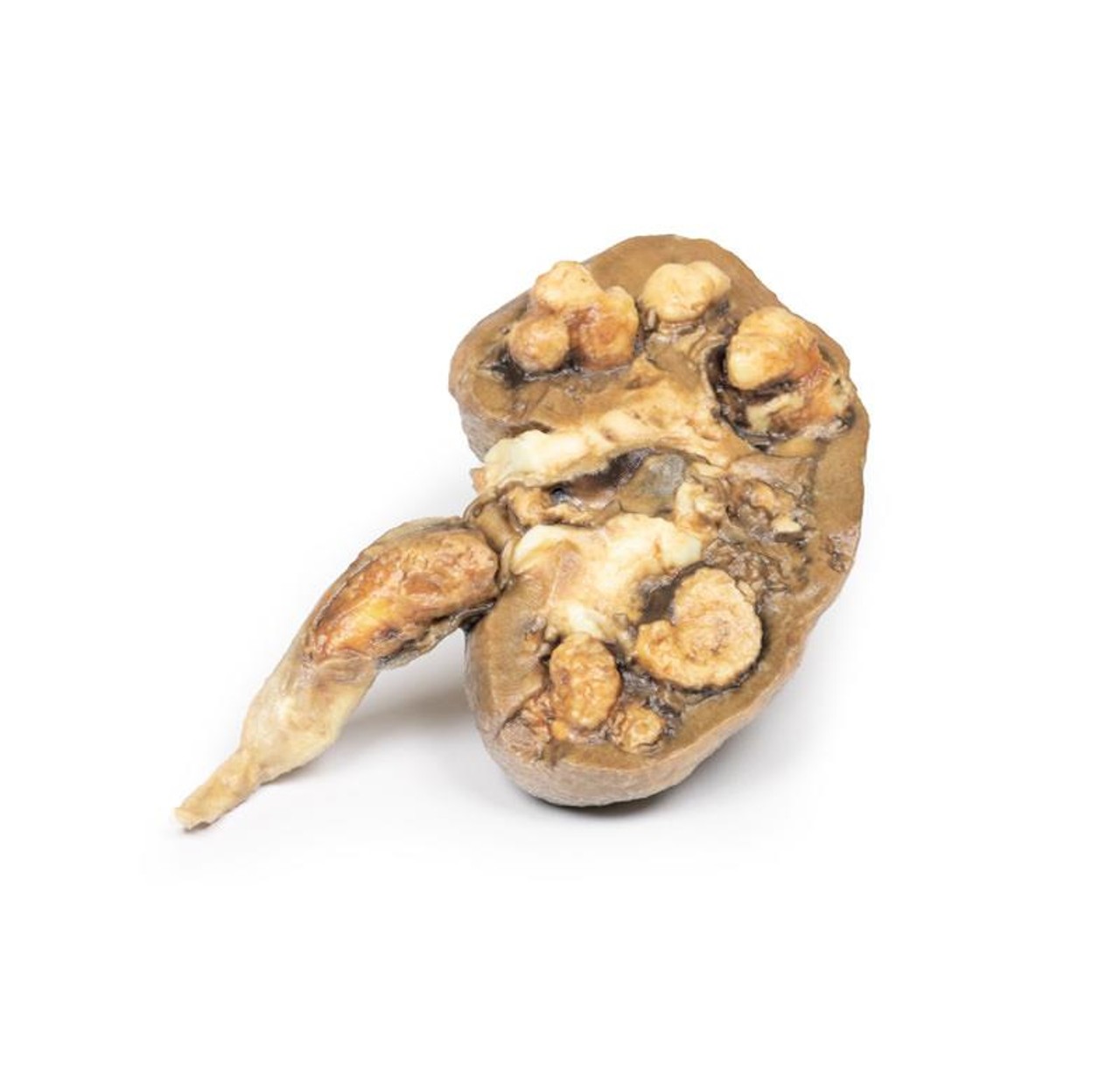 3D Printed Multiple Renal Calculi