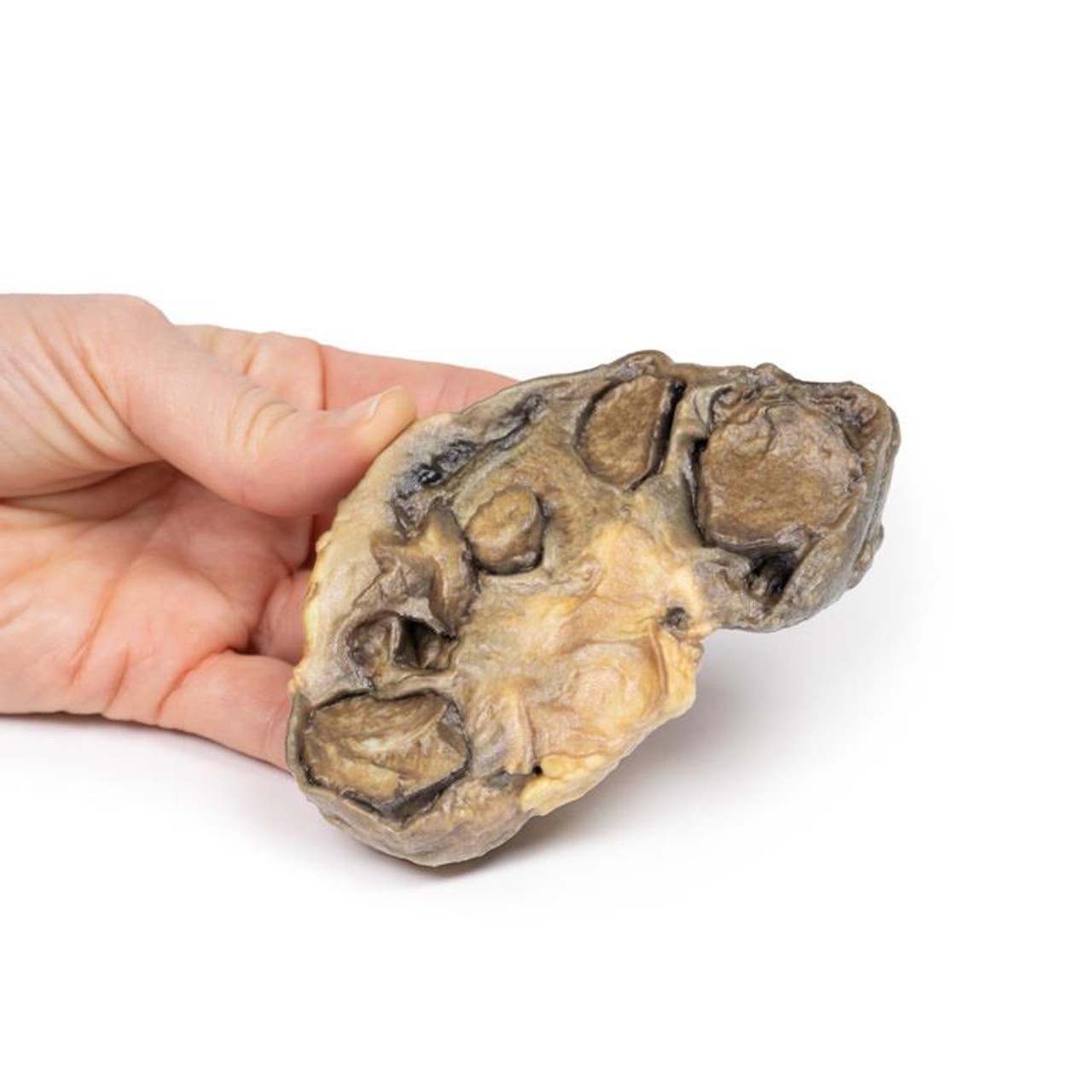 3D Printed Pyonephrosis