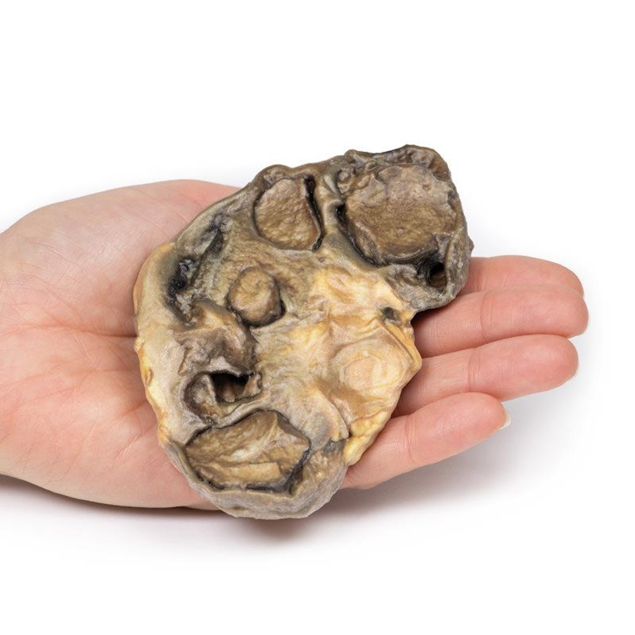 3D Printed Pyonephrosis