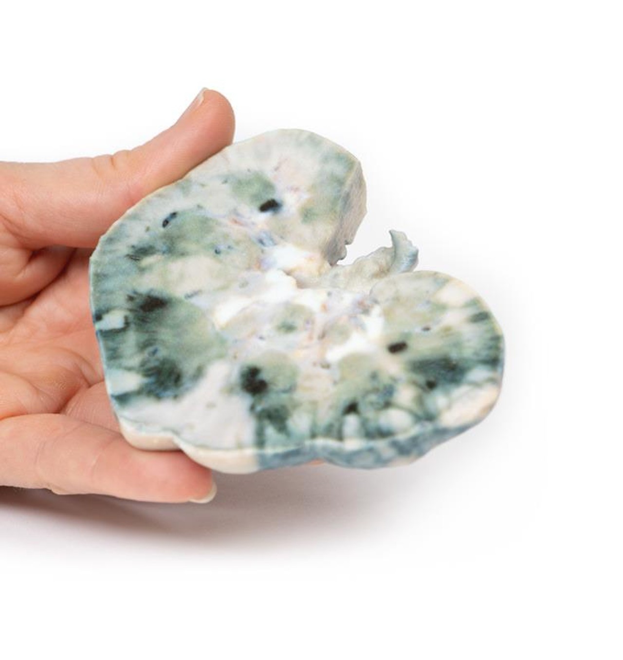 3D Printed Septic Renal Infarct