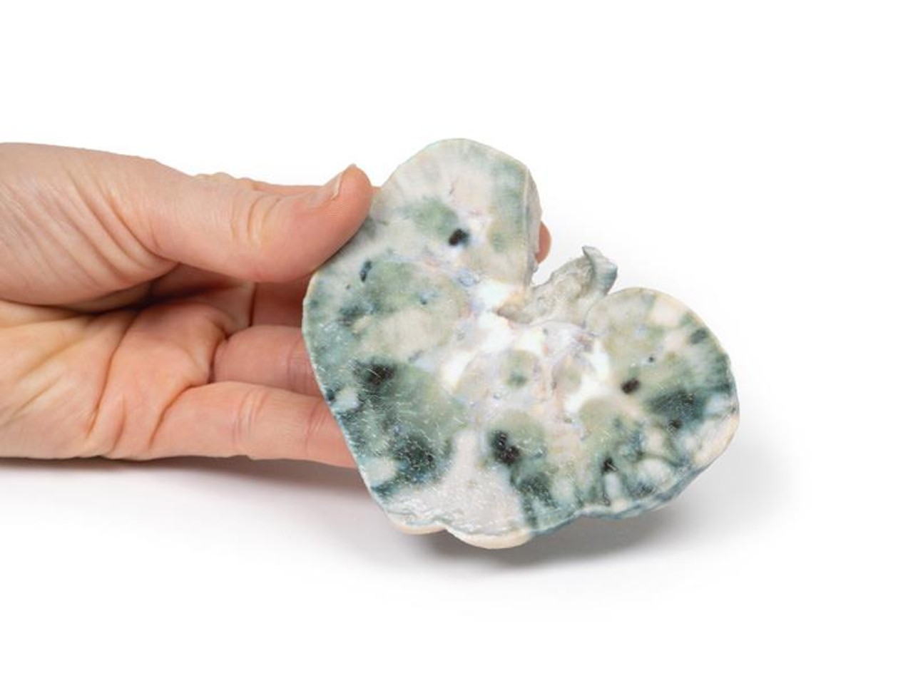 3D Printed Septic Renal Infarct