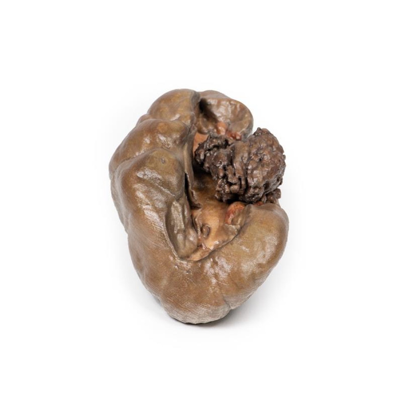 3D Printed Papillary Transitional Cell Carcinoma of the Renal Pelvis
