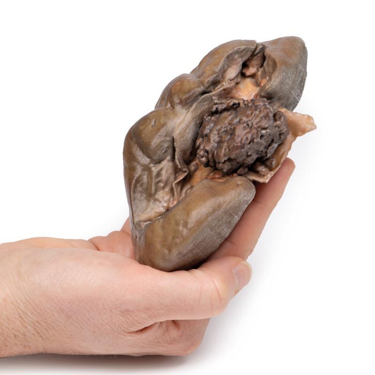 3D Printed Papillary Transitional Cell Carcinoma of the Renal Pelvis