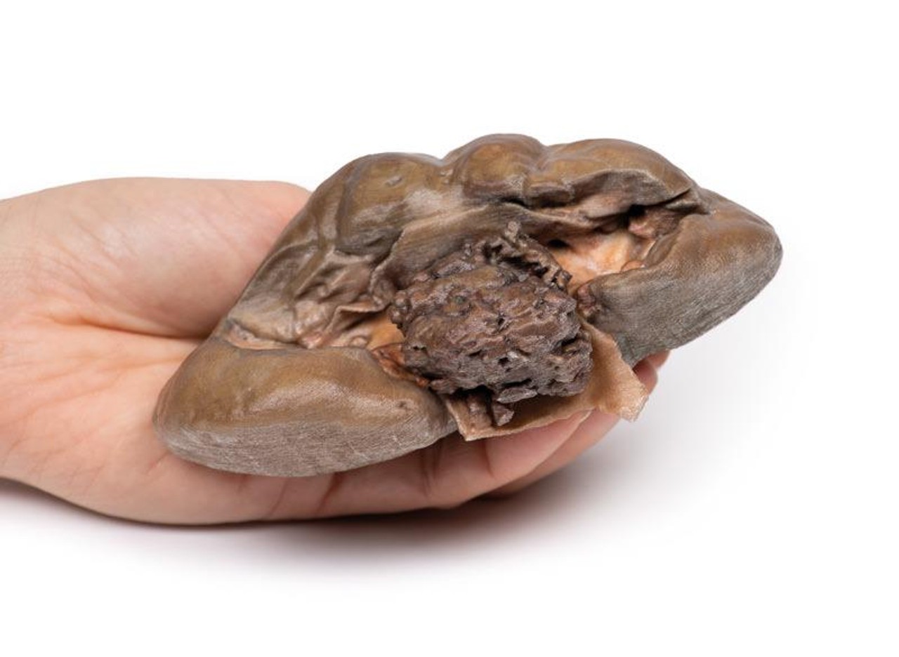 3D Printed Papillary Transitional Cell Carcinoma of the Renal Pelvis