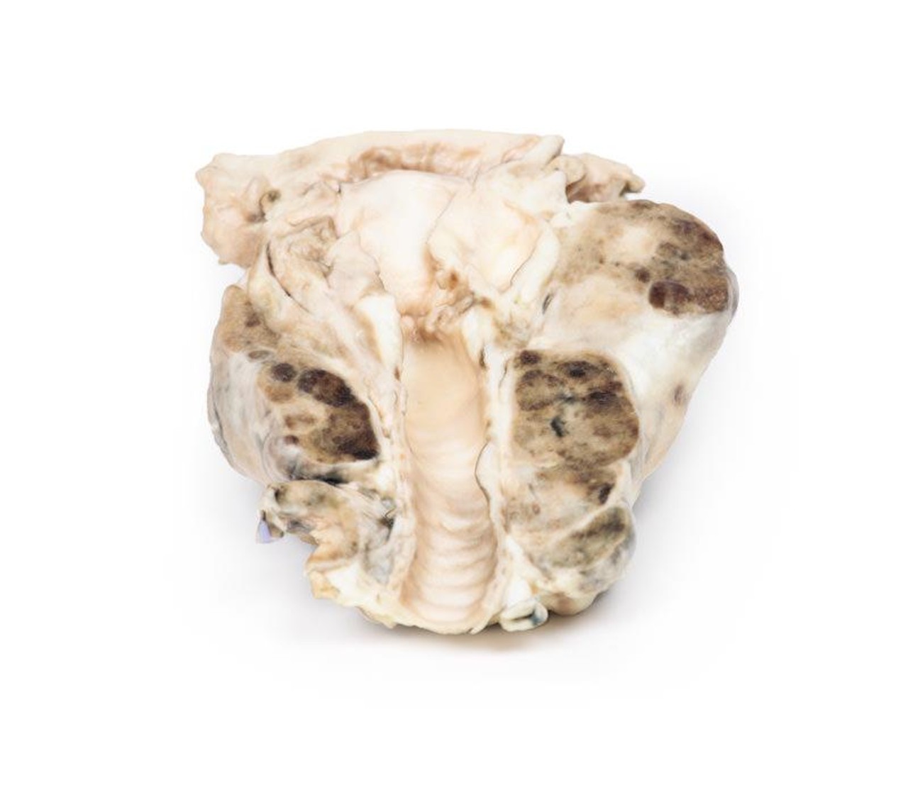 3D Printed Multinodular Goiter