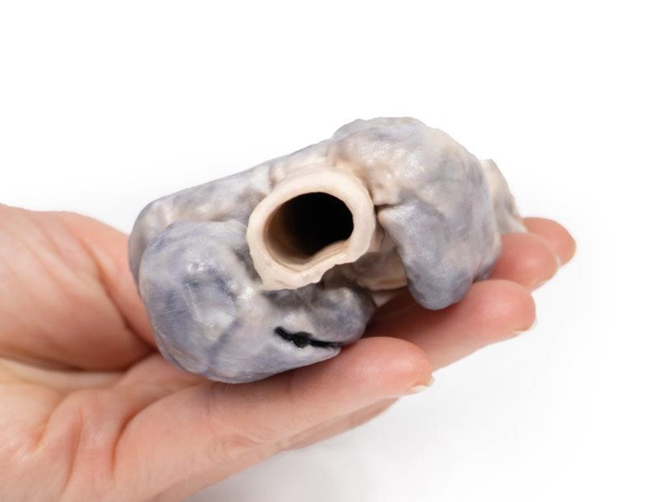 3D Printed Retrosternal Goiter