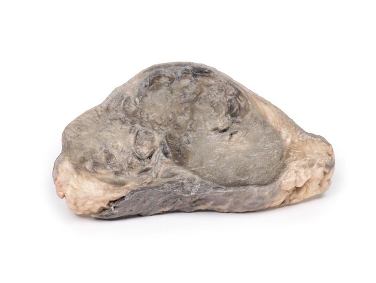 3D Printed Carcinoma of Breast