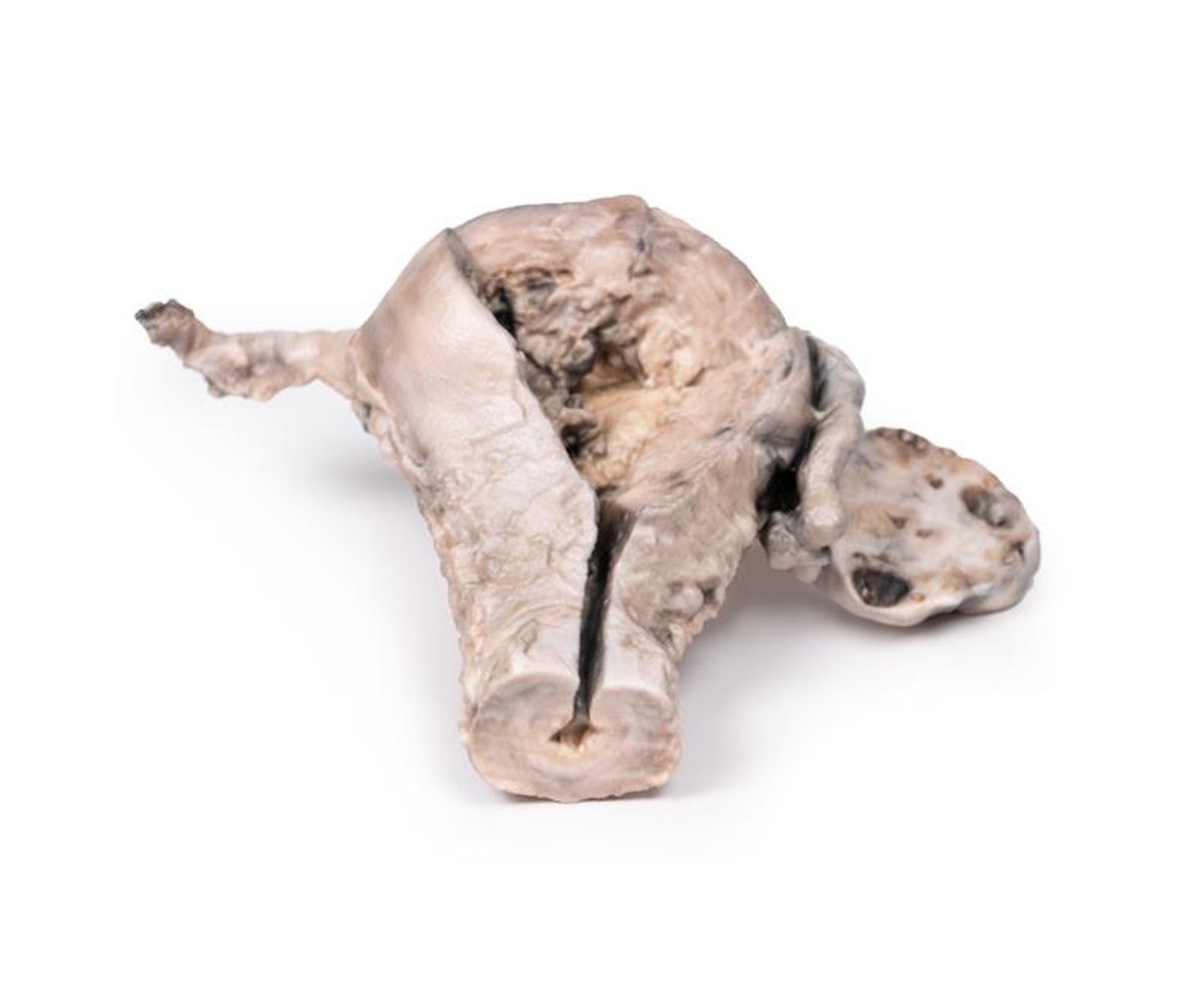3D Printed Endometrial Carcinoma