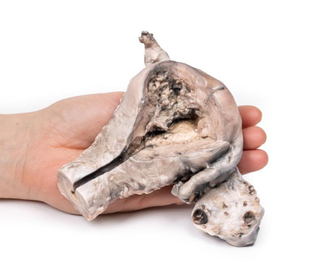 3D Printed Endometrial Carcinoma