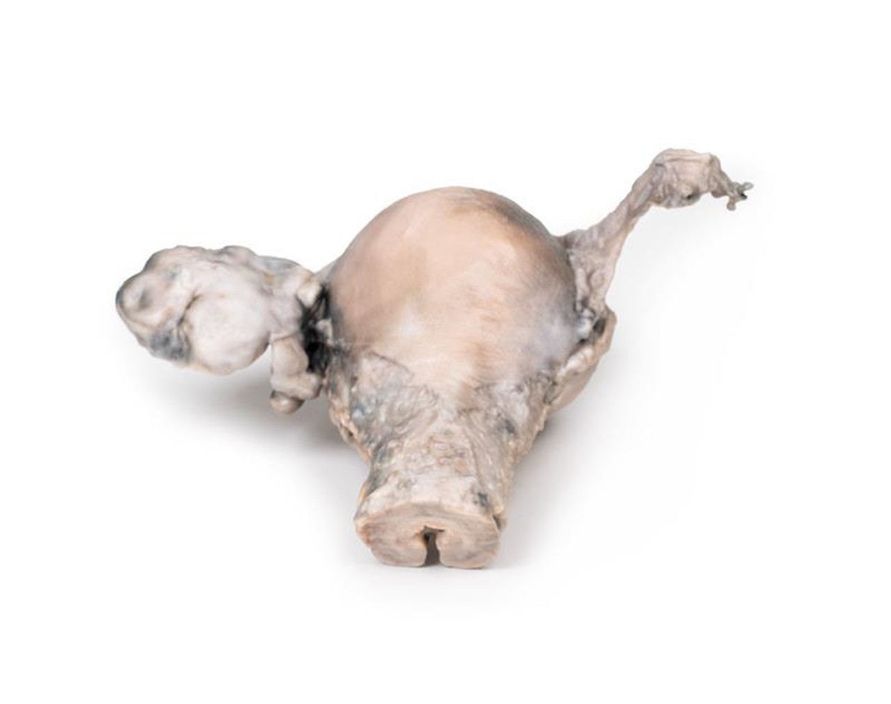 3D Printed Endometrial Carcinoma