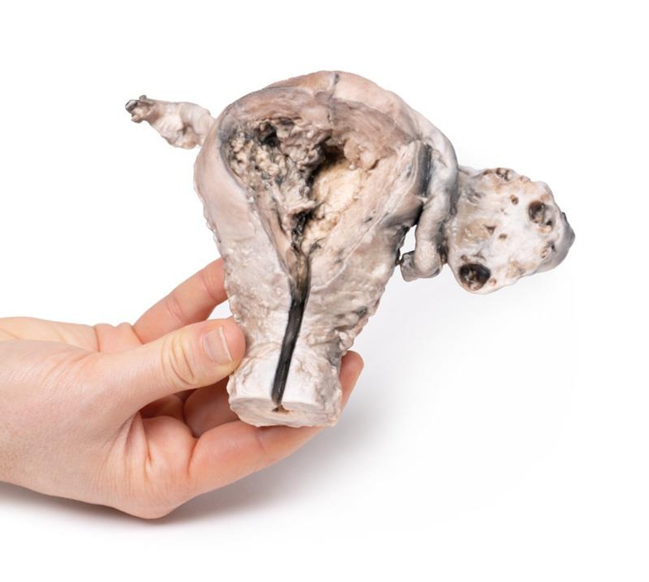 3D Printed Endometrial Carcinoma