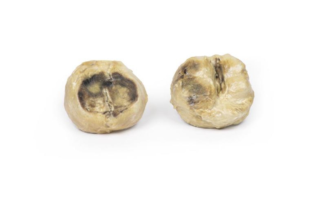 3D Printed Nodular Hyperplasia of the Prostate