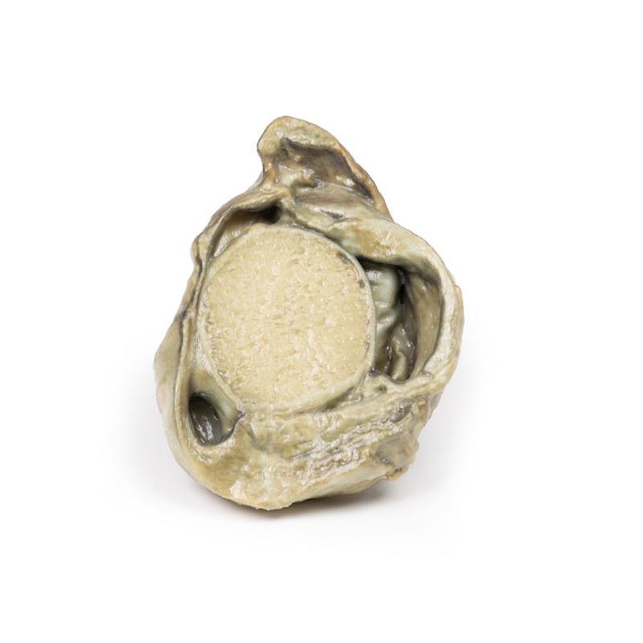 3D Printed Hydrocoele