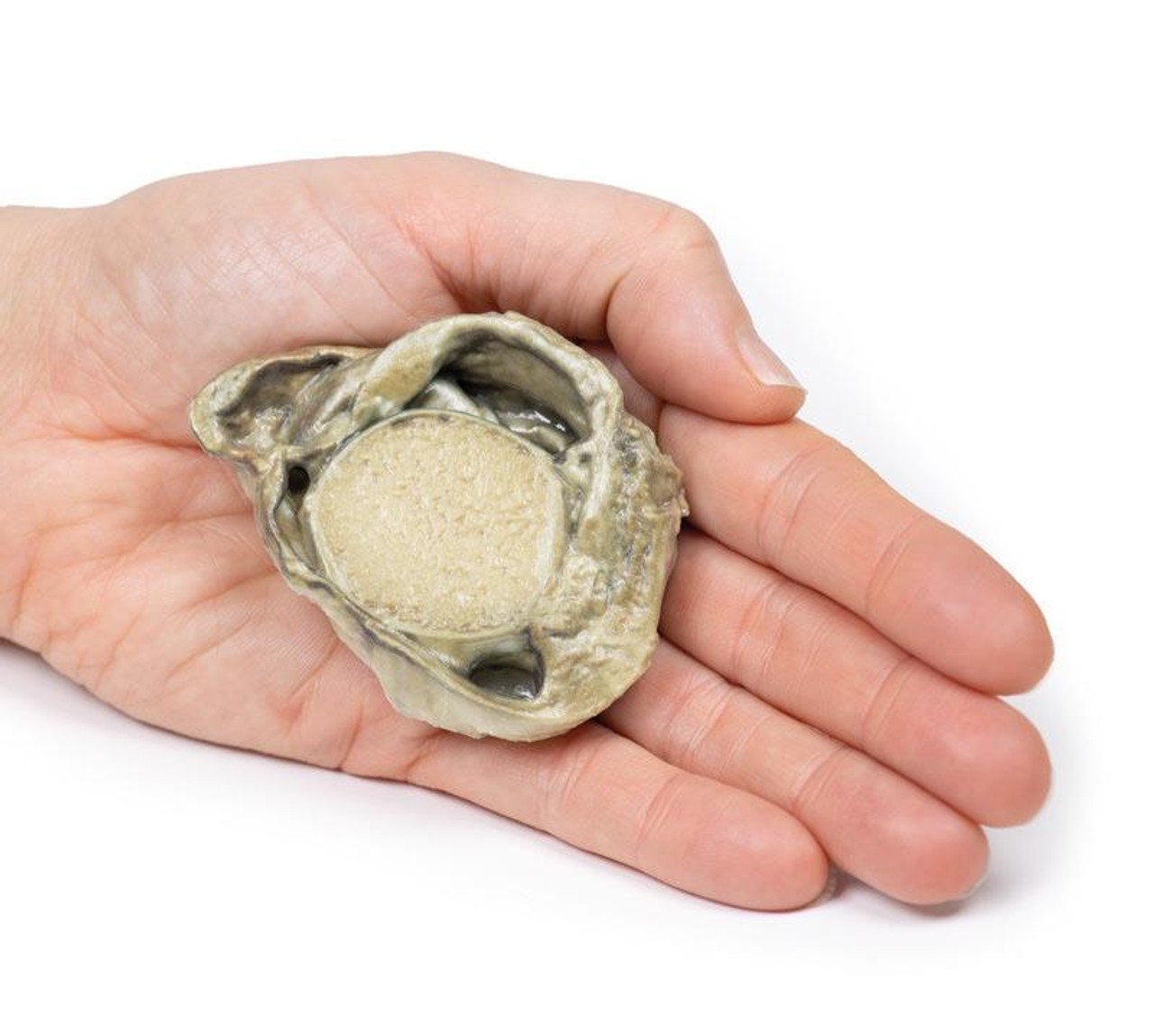 3D Printed Hydrocoele