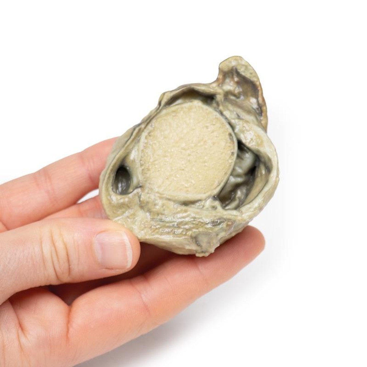 3D Printed Hydrocoele