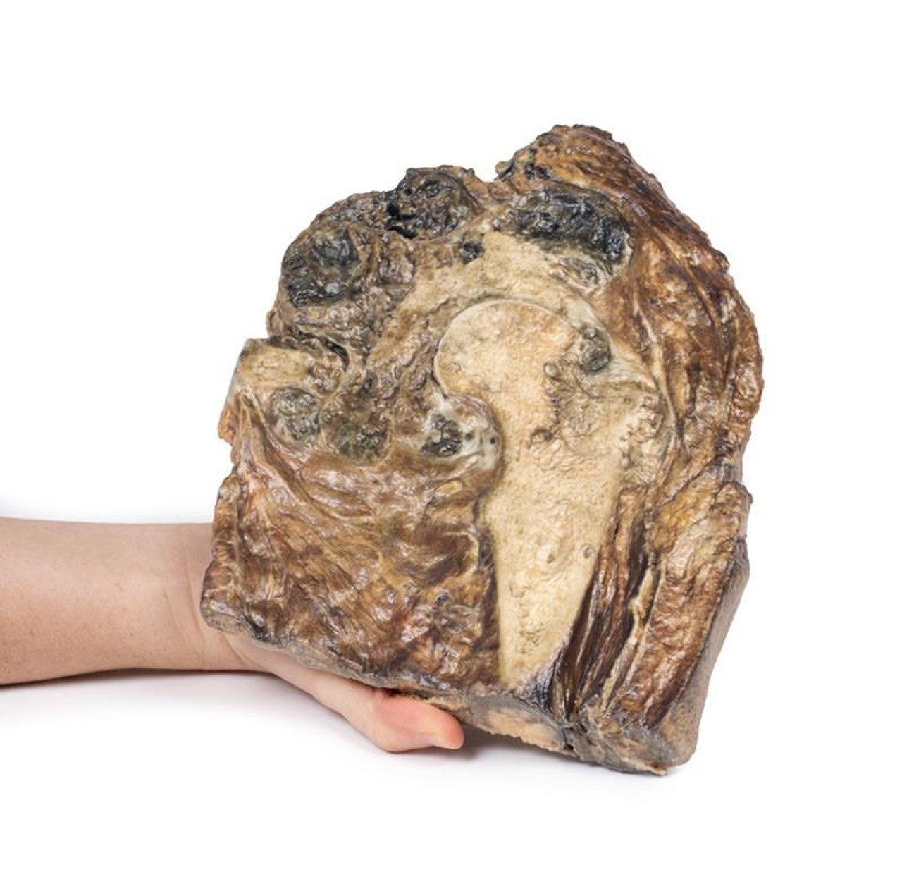 3D Printed Chondrosarcoma of Femur and Ilium