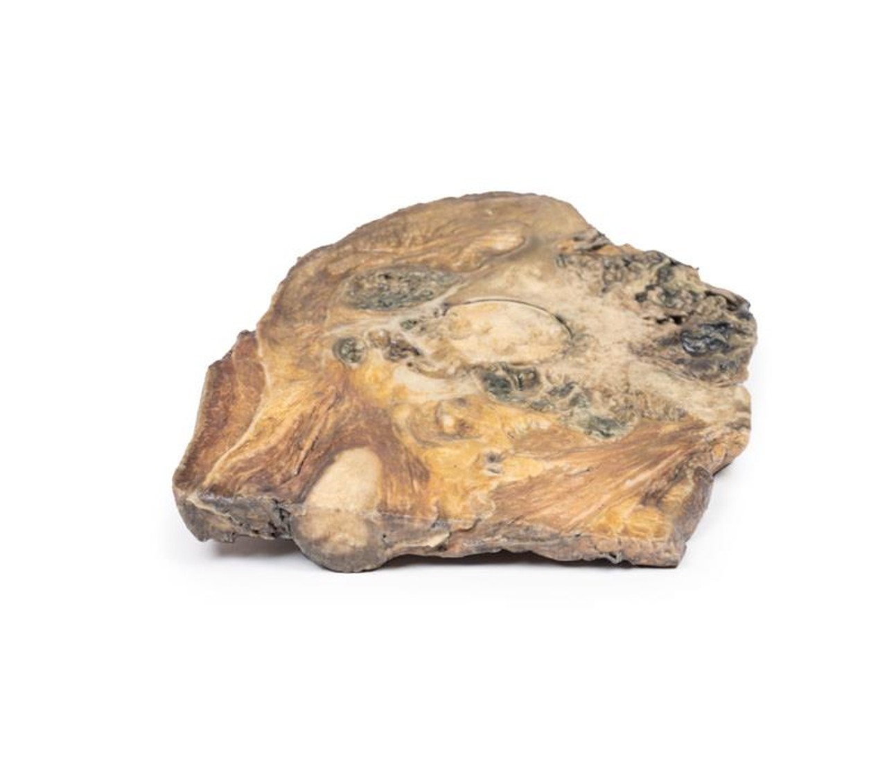 3D Printed Chondrosarcoma of Femur and Ilium