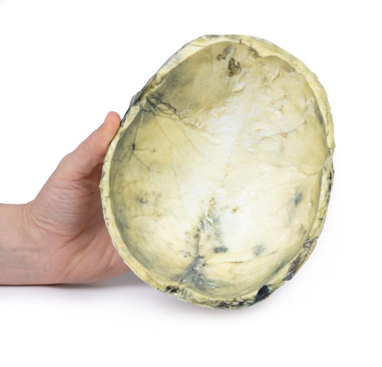 3D Printed Tertiary Syphilis