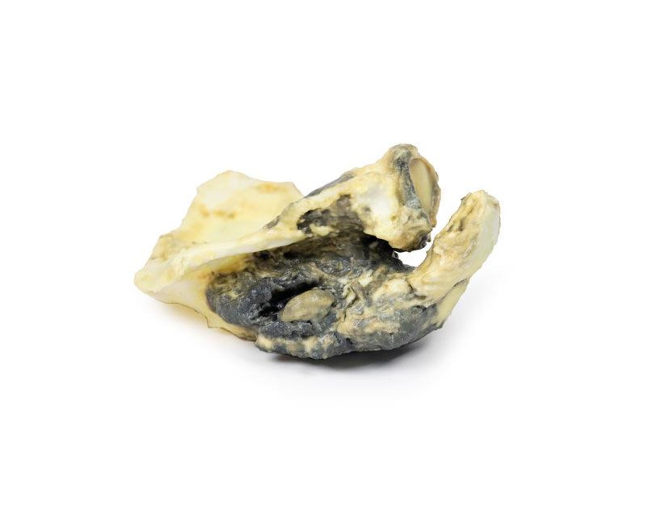 3D Printed Chondrosarcoma of Scapula