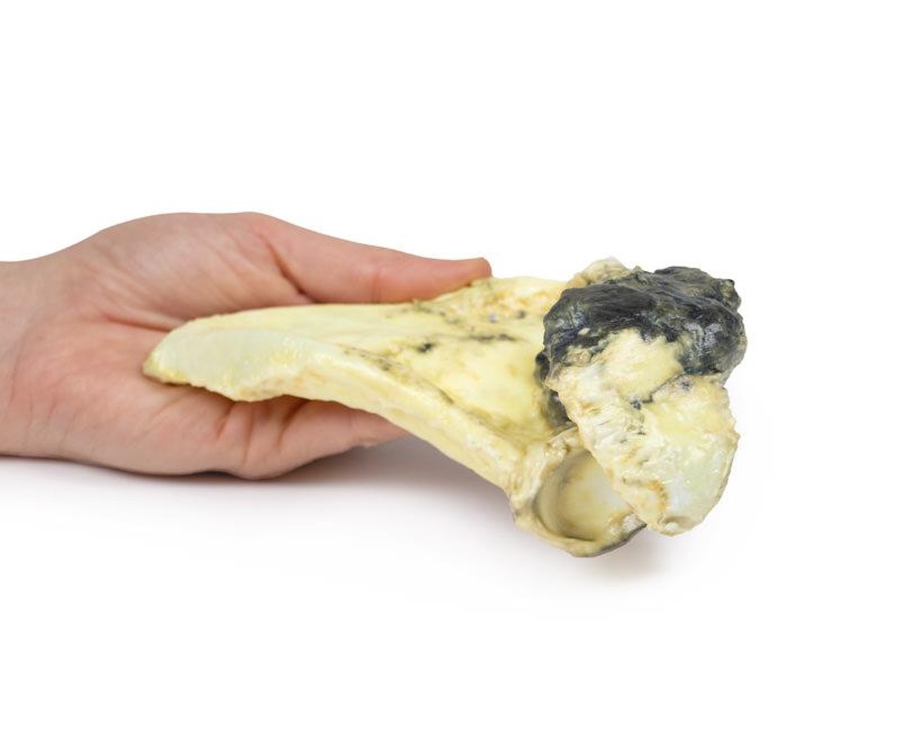 3D Printed Chondrosarcoma of Scapula