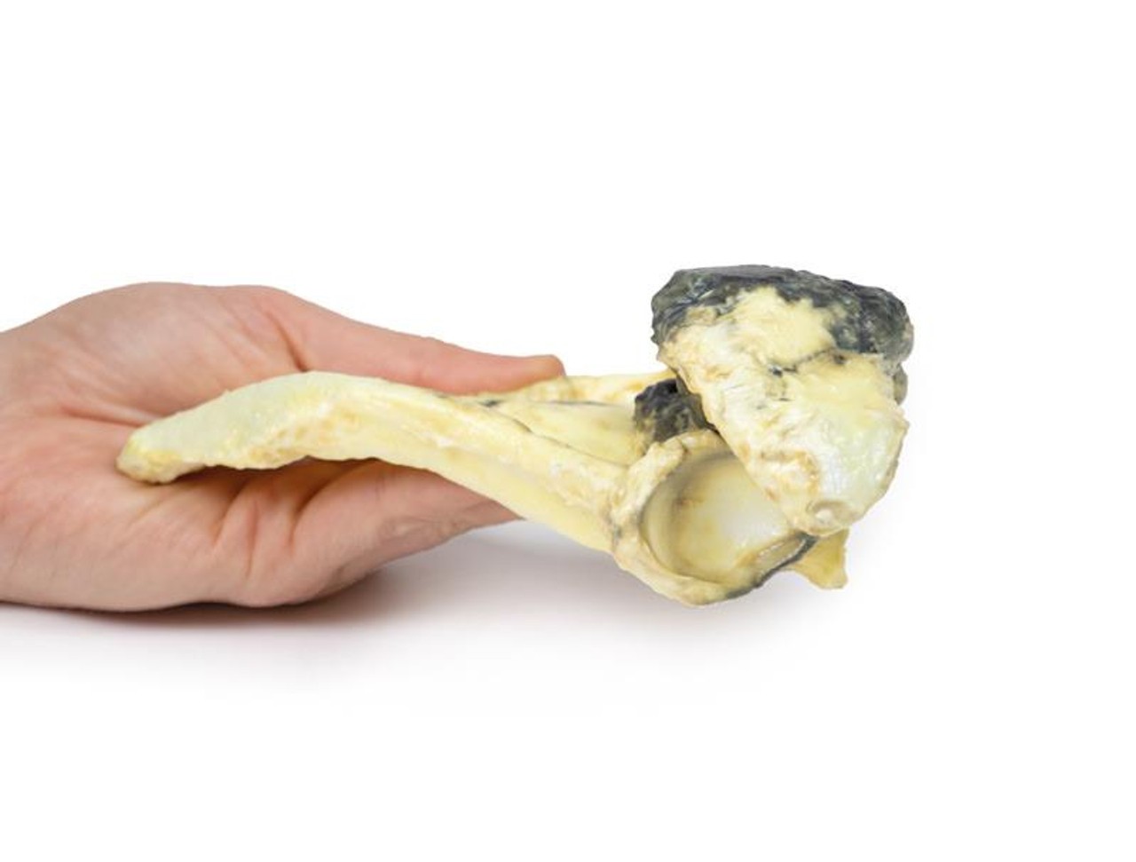 3D Printed Chondrosarcoma of Scapula