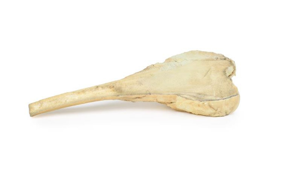 3D Printed Osteosarcoma of the Distal Femur