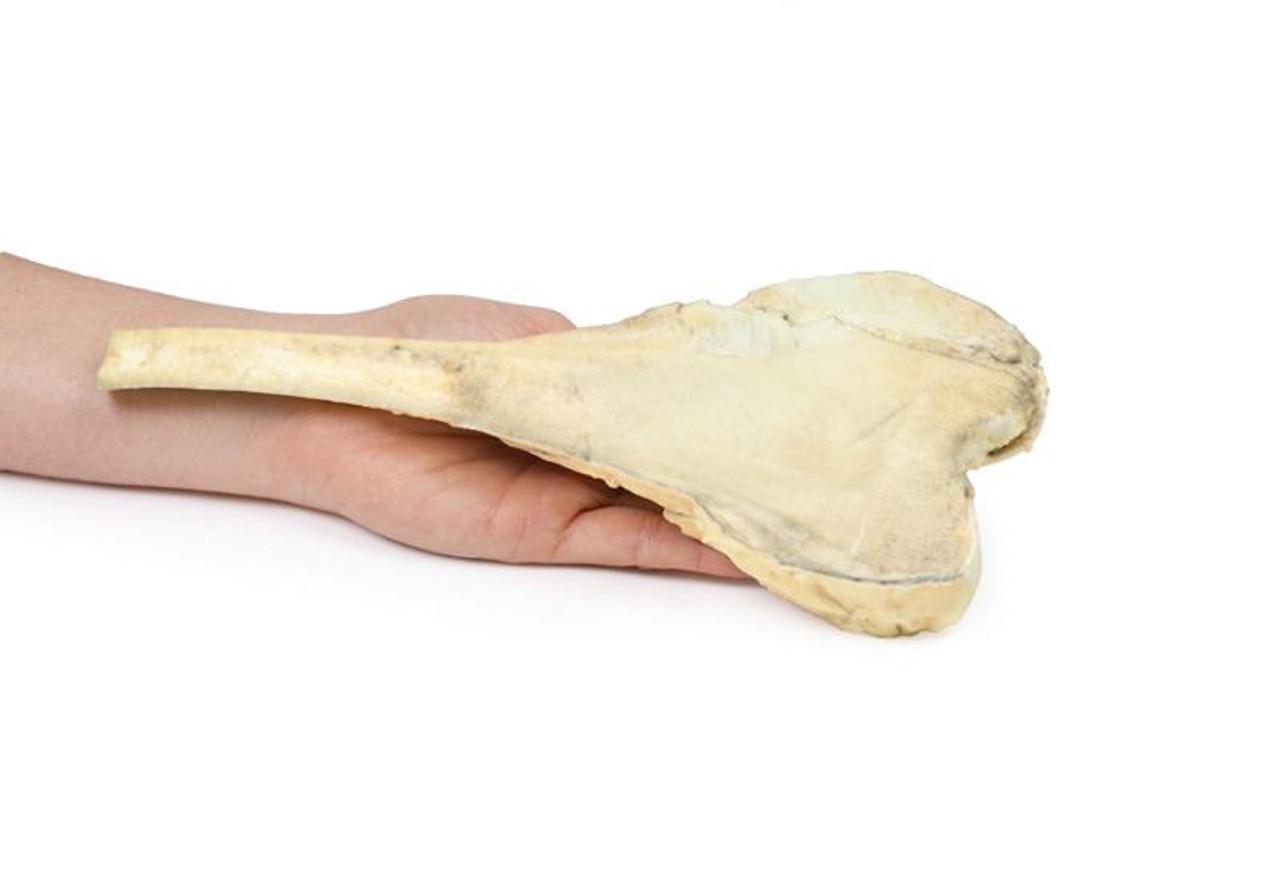 3D Printed Osteosarcoma of the Distal Femur