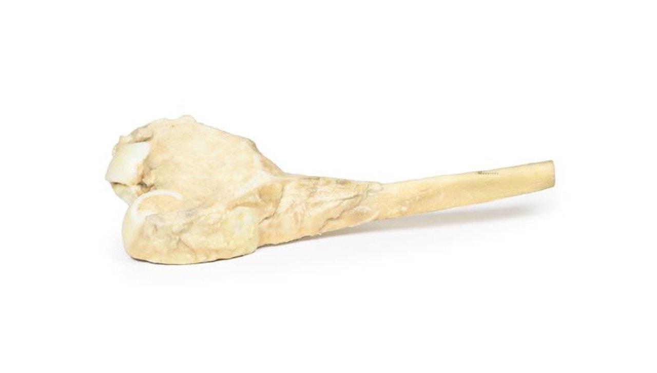 3D Printed Osteosarcoma of the Distal Femur