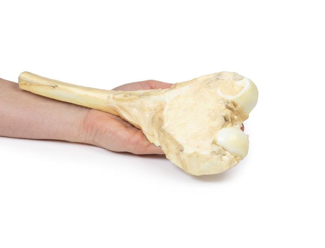 3D Printed Osteosarcoma of the Distal Femur