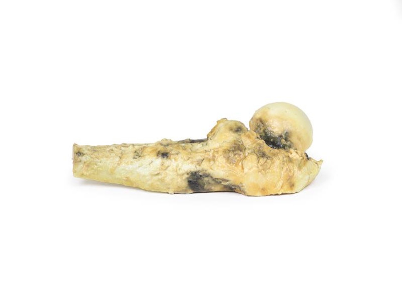 3D Printed Osteosarcoma of the Proximal Femur
