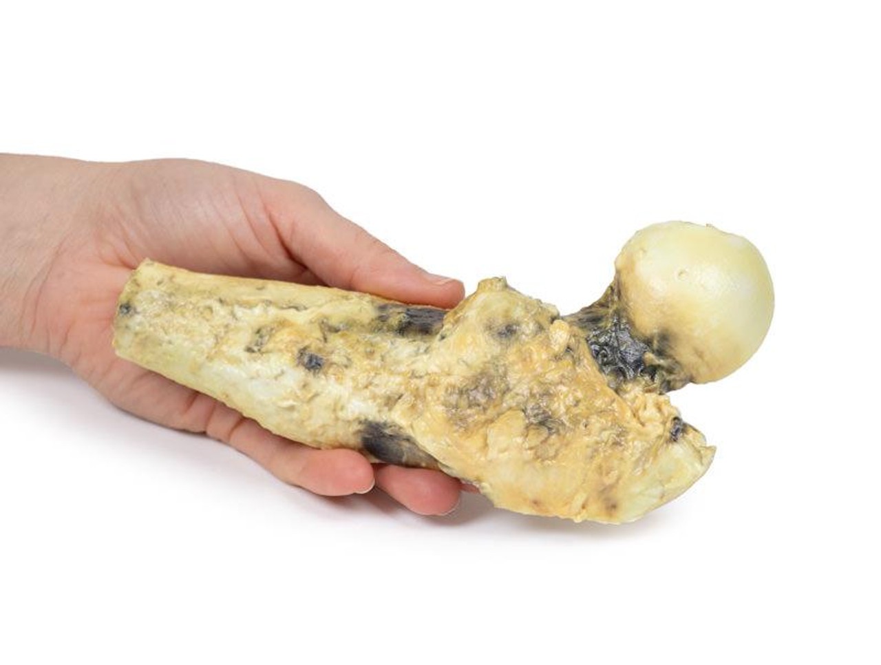 3D Printed Osteosarcoma of the Proximal Femur