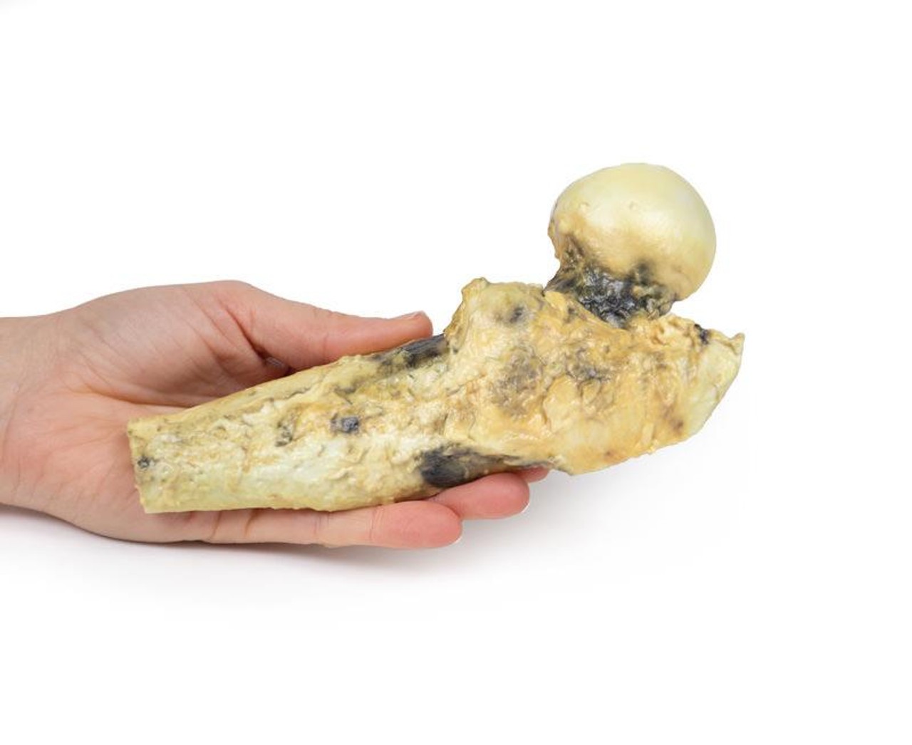 3D Printed Osteosarcoma of the Proximal Femur