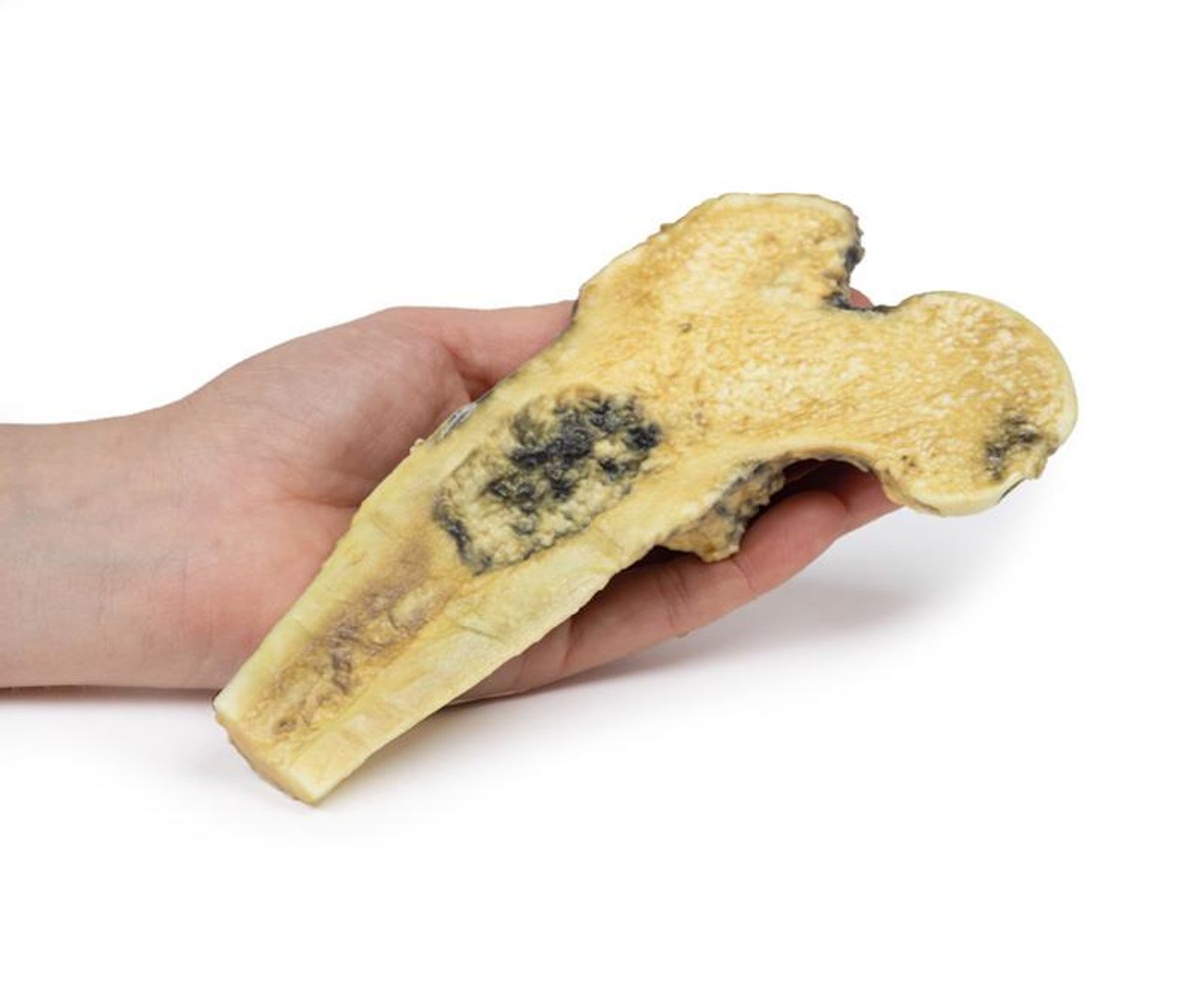 3D Printed Osteosarcoma of the Proximal Femur