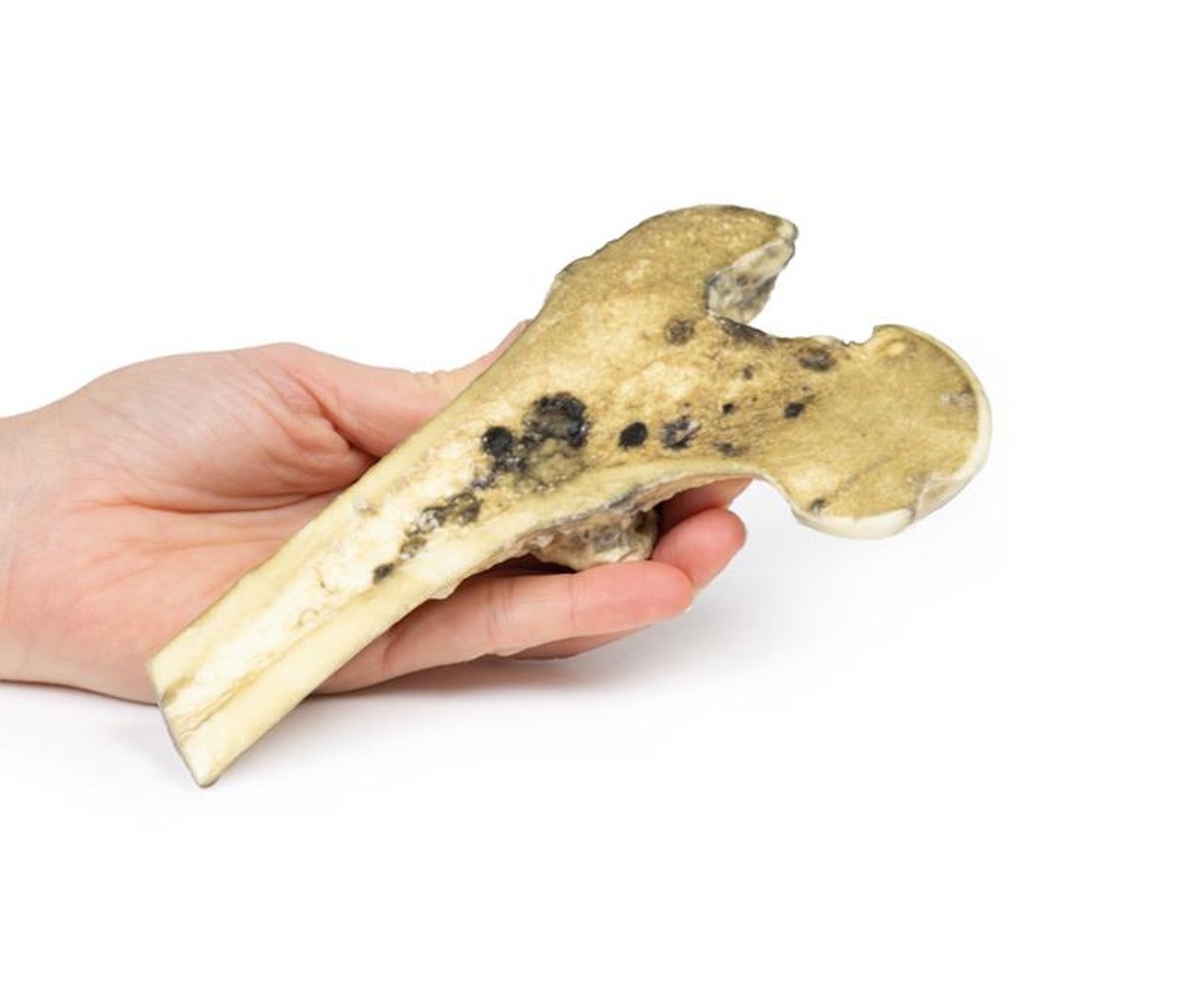 3D Printed Metastatic Malignant Melanoma
