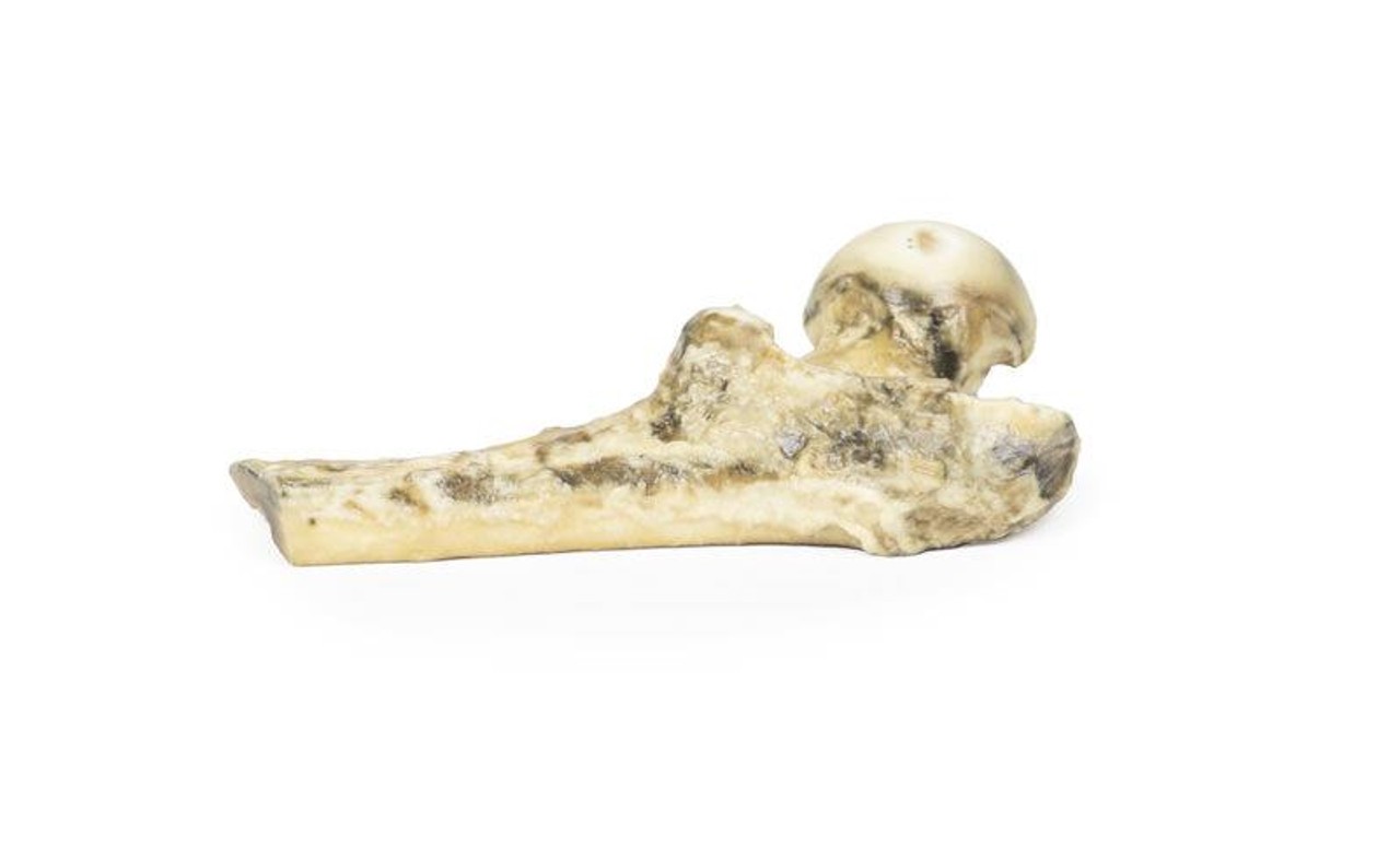 3D Printed Metastatic Malignant Melanoma