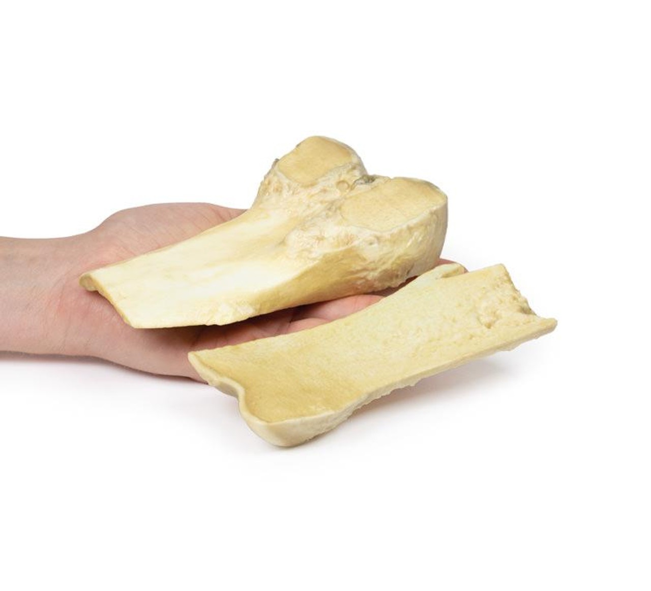 3D Printed Osteochondroma