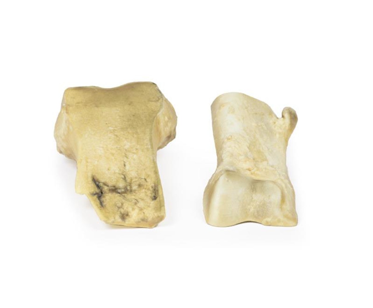3D Printed Osteochondroma