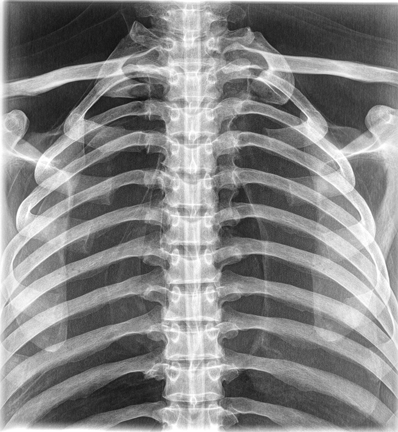 X-Ray Thorax