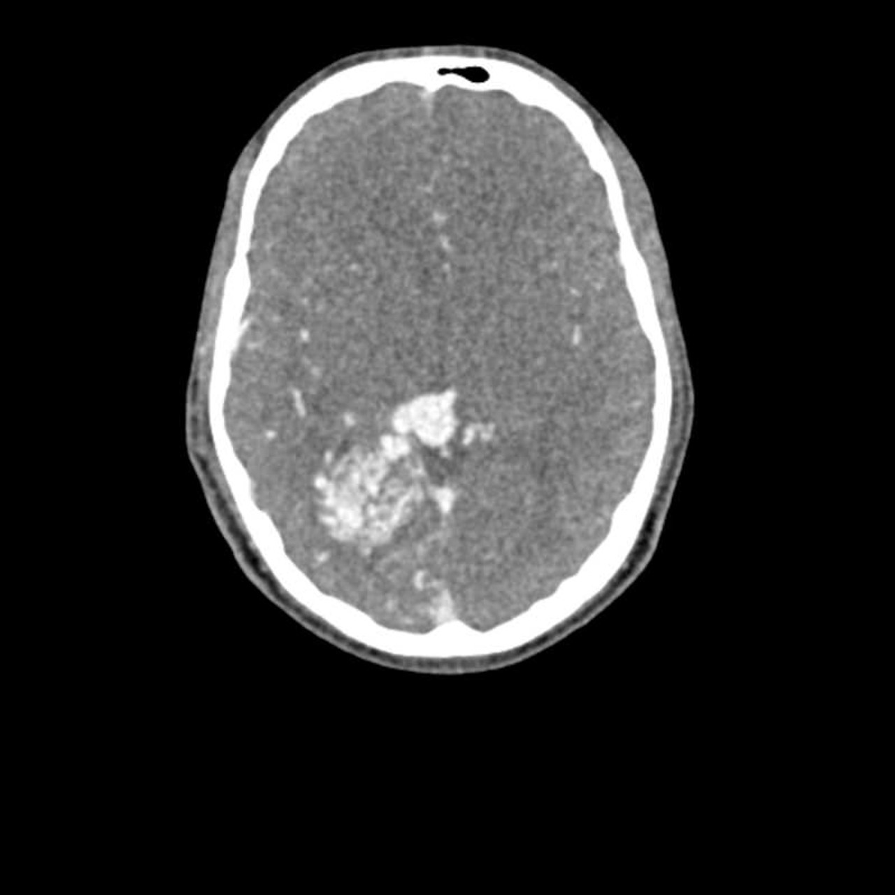 Head and Neck Phantom for CT, X-Ray and Radiation Therapy