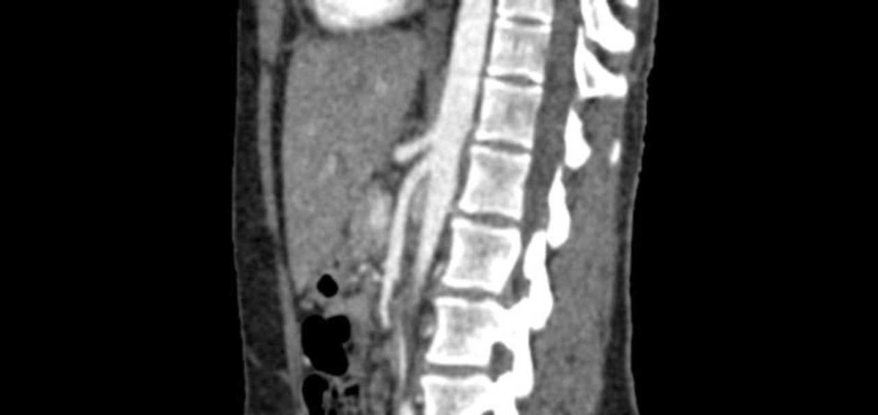 Abdomen Phantom for CT, X-Ray and Radiation Therapy
