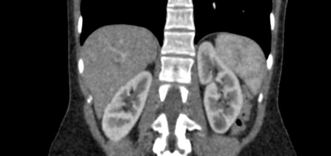 Abdomen Phantom for CT, X-Ray and Radiation Therapy