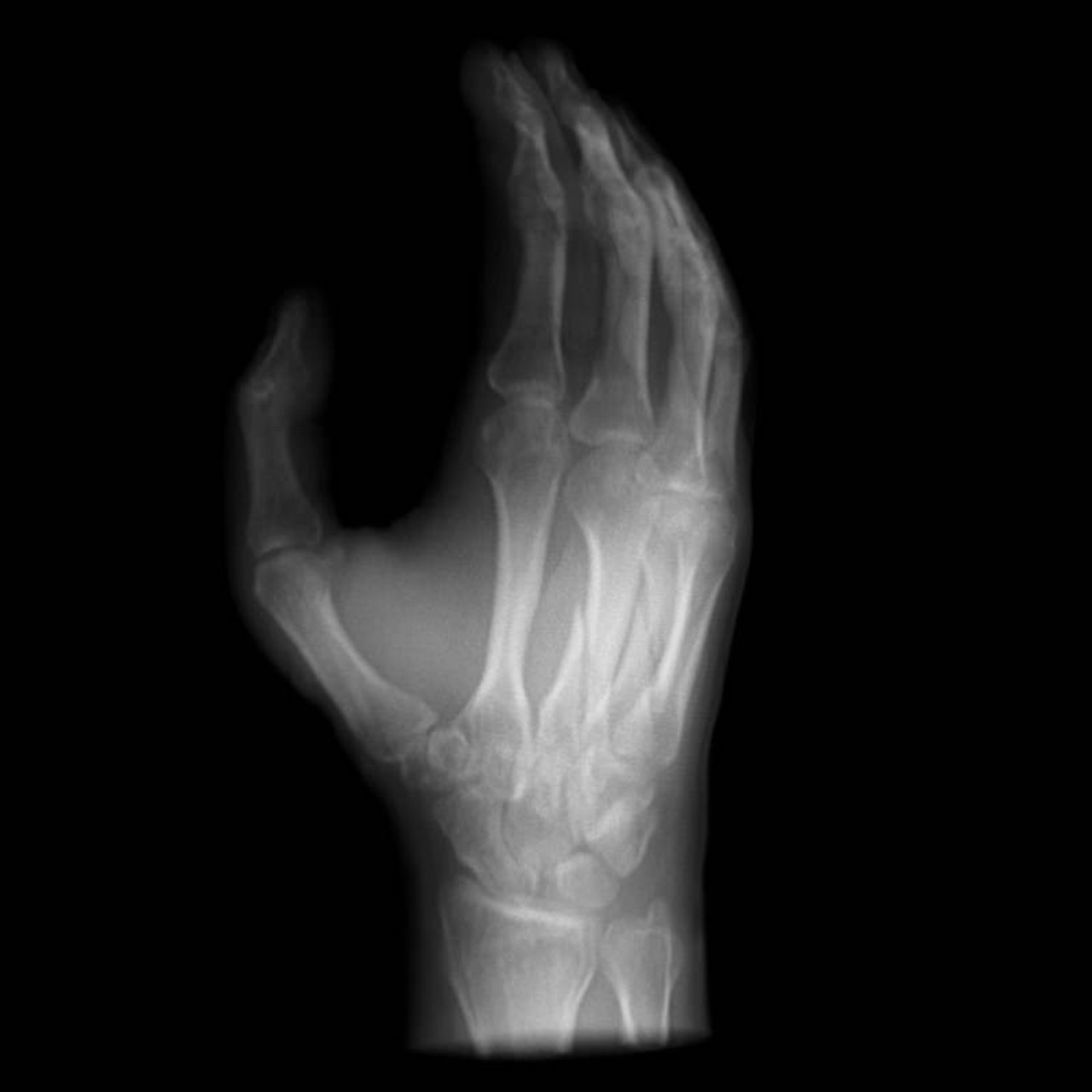 Hand Phantom for CT, X-Ray and Radiation Therapy