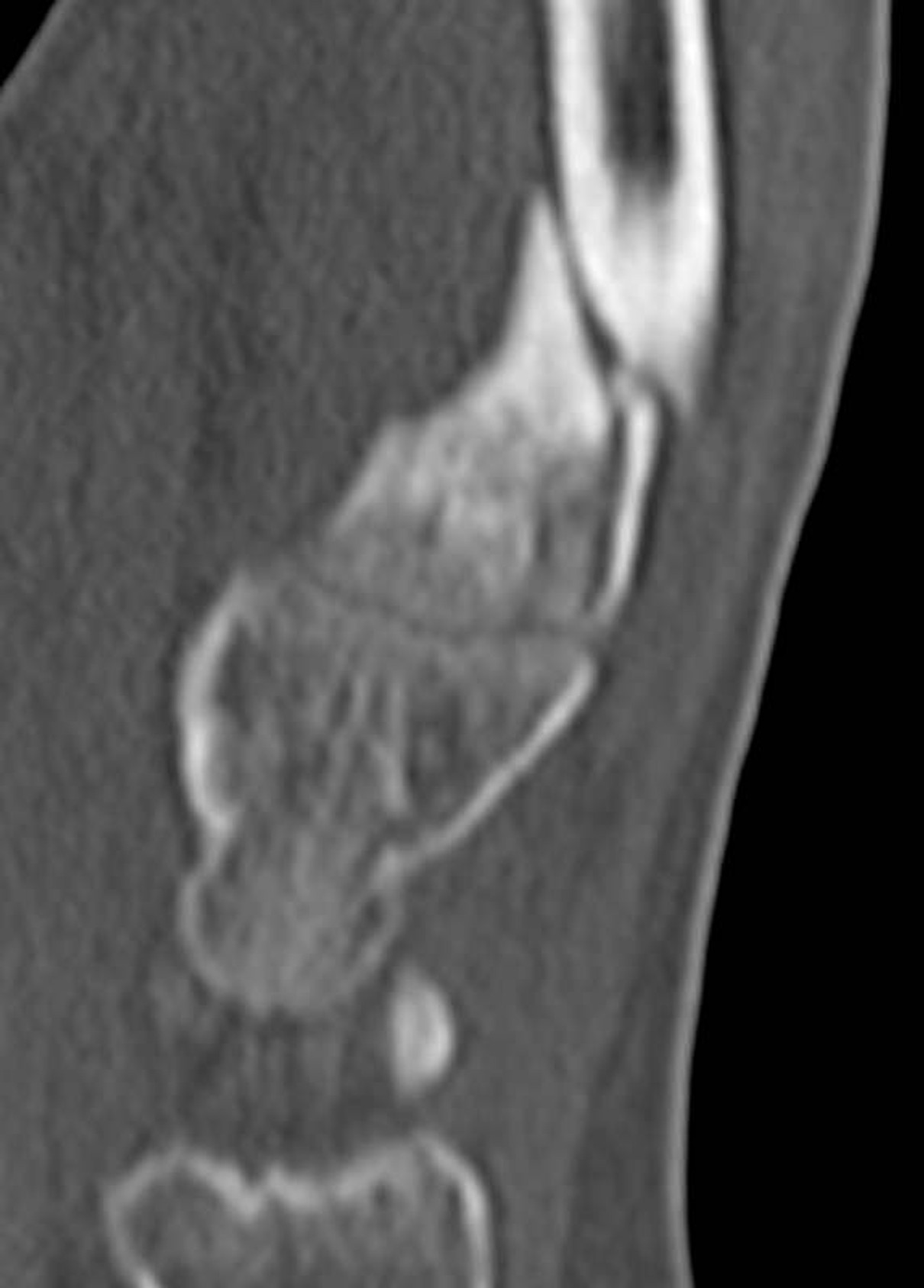 Hand Phantom for CT, X-Ray and Radiation Therapy